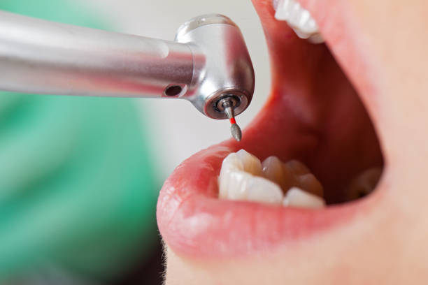 Best Emergency Wisdom Tooth Extraction in Tonganoxie, KS